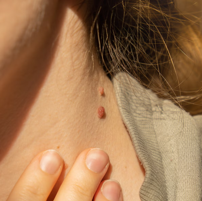 skin tags removal at home