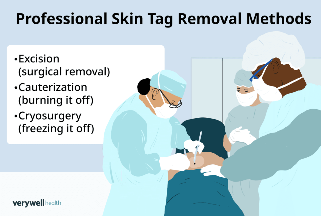 skin removal by professionals